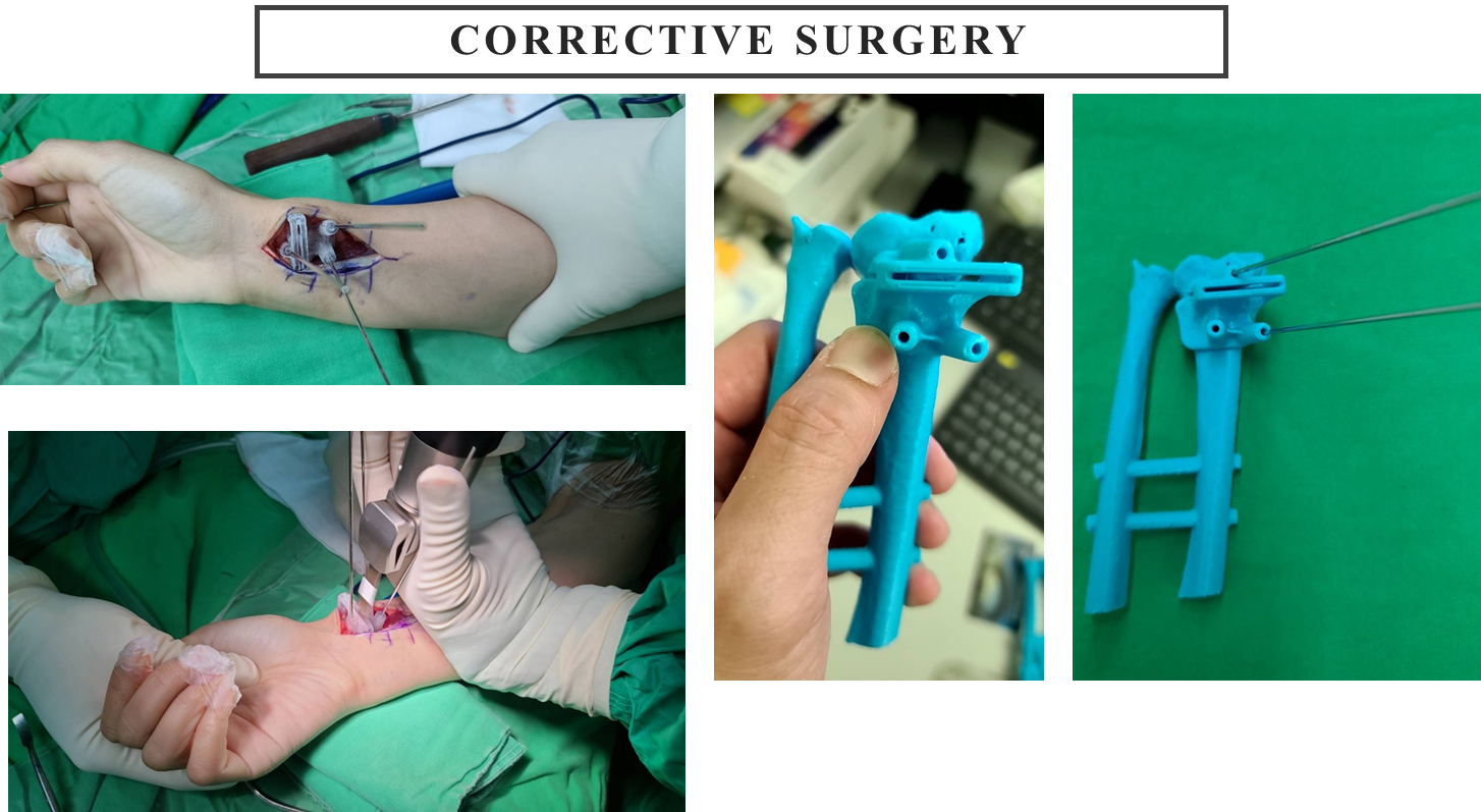 corrective surgery